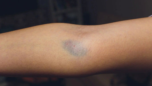 How-Long-Do-Bruises-Take-to-Heal-A-Simple-Recovery-Timeline-Featured-Image