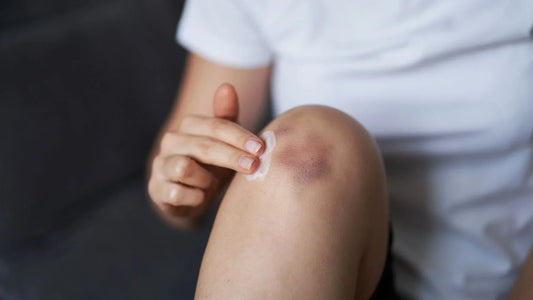 The-Ultimate-Guide-to-Bruise-Cream